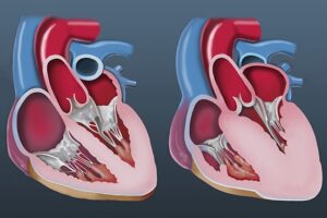 New Drug, Positive Results for Hypertrophic Cardiomyopathy