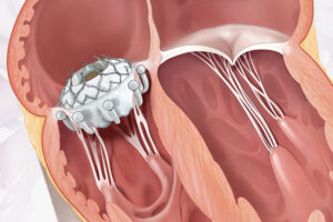 New Clinical Trial for Evoque Valve Comes to Valvular Heart Disease Center