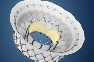 Valve Team Performs First Transseptal Transcatheter Mitral Valve Replacement