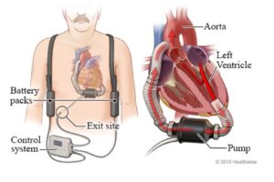 VAD Program Celebrates 25 Years