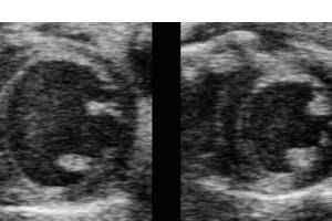 Radiation therapy may be potential heart failure treatment