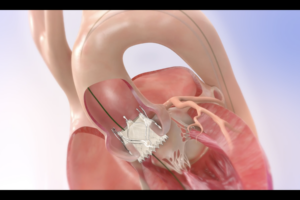 Structural Intervention Group Performs first St. Louis Jena Valve Procedure