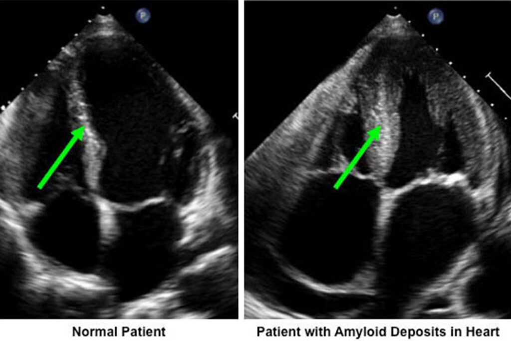 Amyloidosis Cardiovascular Division 8016