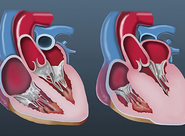 New Drug, Positive Results for Hypertrophic Cardiomyopathy